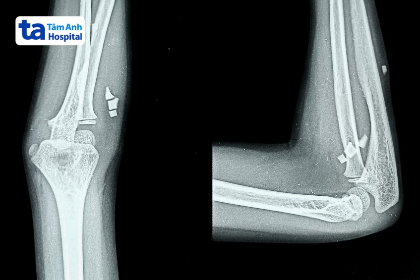 ảnh x quang khuỷu tay