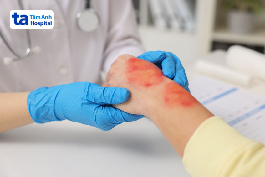 Bé bị bỏng nước soi nên bôi gì cho mau khỏe