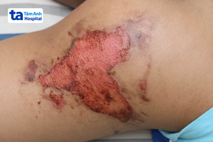 Bé bị bỏng bô ống xe máy