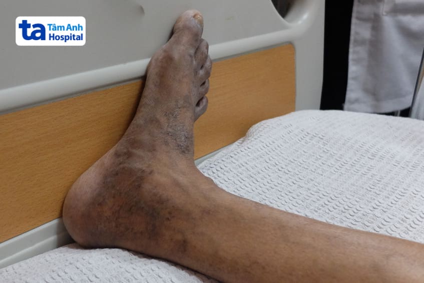 Bệnh nhân giãn tĩnh mạch nông da đổi màu chỉ dịnh siêu âm Doppler tĩnh mạch chi dưới