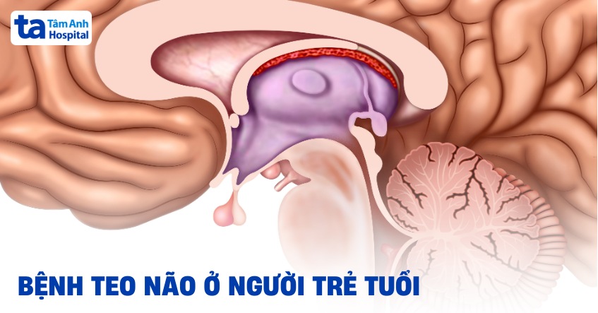 Bệnh teo não ở người trẻ tuổi: Triệu chứng, nguyên nhân và chẩn đoán