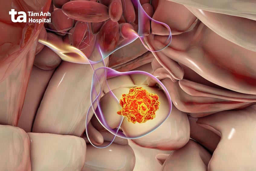 bệnh u tuyến yên