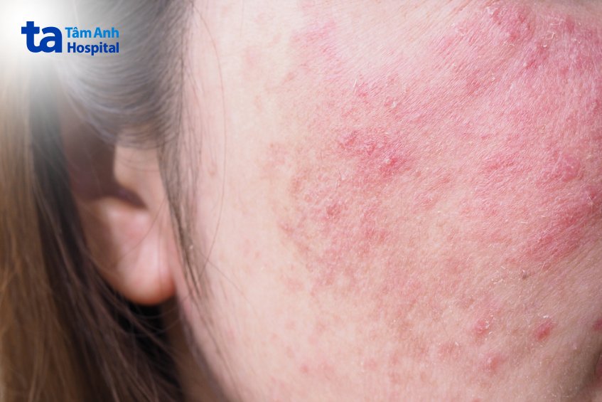 bị kích ứng da