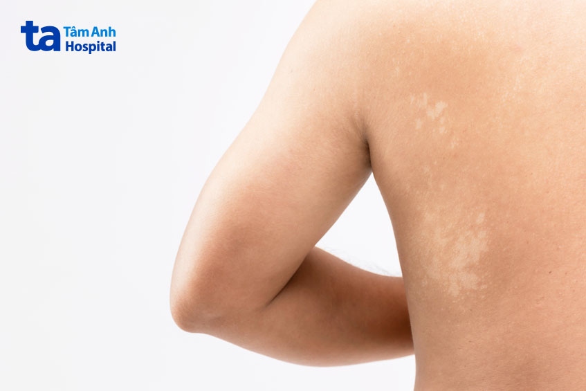 bị lang ben ở lưng có nguy hiểm không