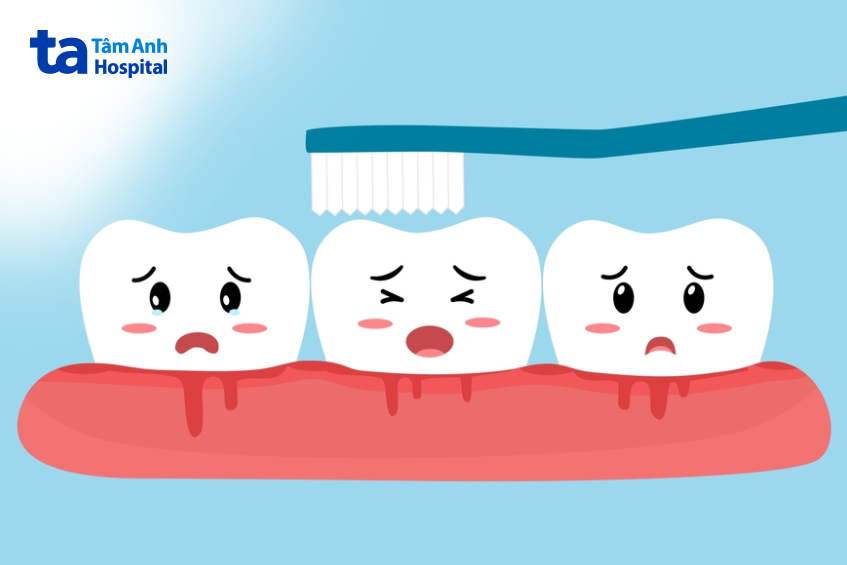 Các yếu tố làm tăng nguy cơ bị sưng lợi