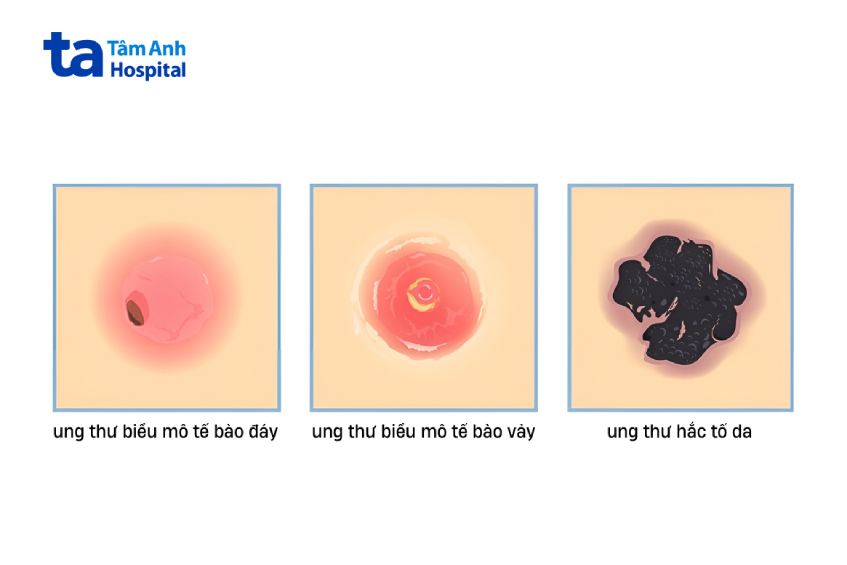 Biểu hiện của 3 dạng ung thư da