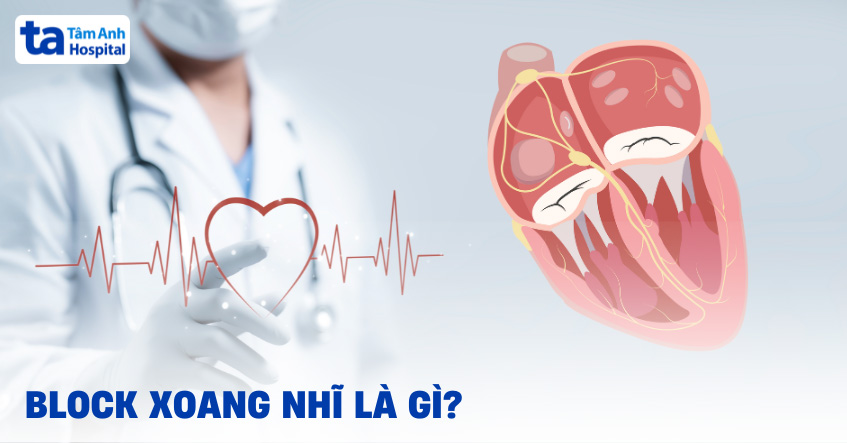 Block xoang nhĩ là gì? Nguyên nhân, triệu chứng và chẩn đoán