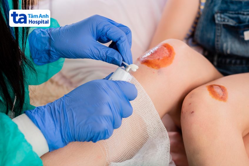 Bôi thuốc lên vết bỏng theo chỉ định của bác sĩ