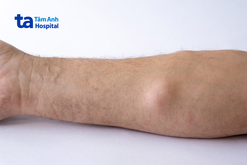 bướu mỡ thường phát triển dưới cánh tay