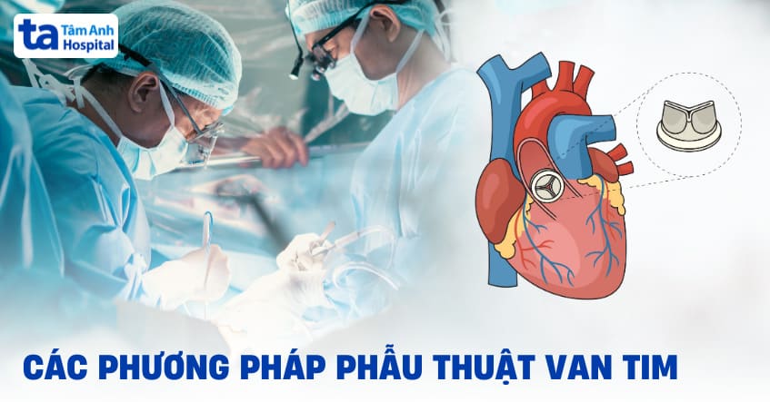 Các phương pháp phẫu thuật van tim