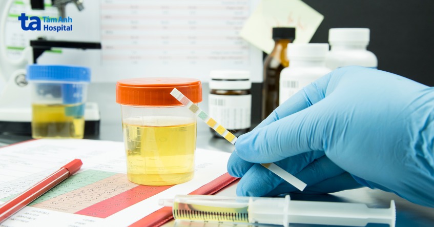 các triệu chứng đặc hiệu viêm cầu thận thường chỉ được nhận thấy qua kết quả xét nghiệm nước tiểu