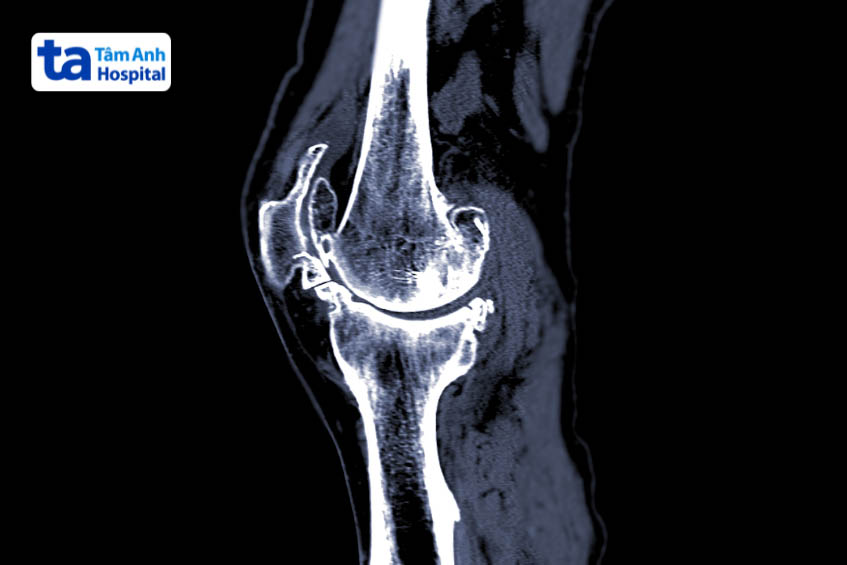cách chẩn đoán khớp gối kêu lục cục