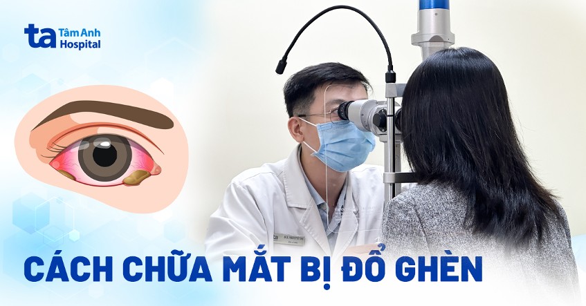 3 cách chữa mắt bị đổ ghèn ở người lớn hiệu quả giúp mau hồi phục