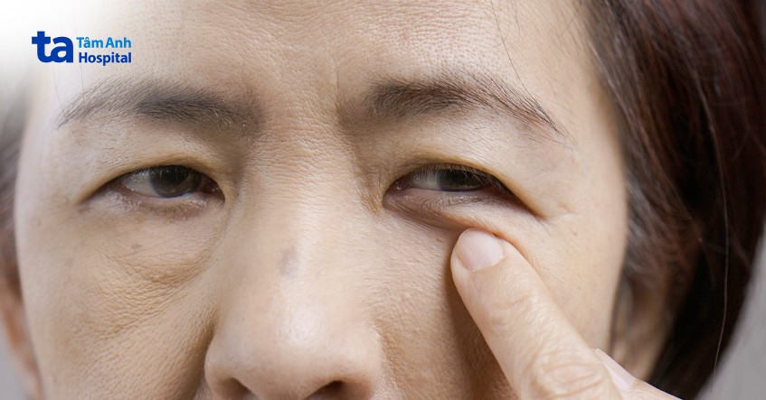 cao tuổi dễ bị thoái hóa võng mạc