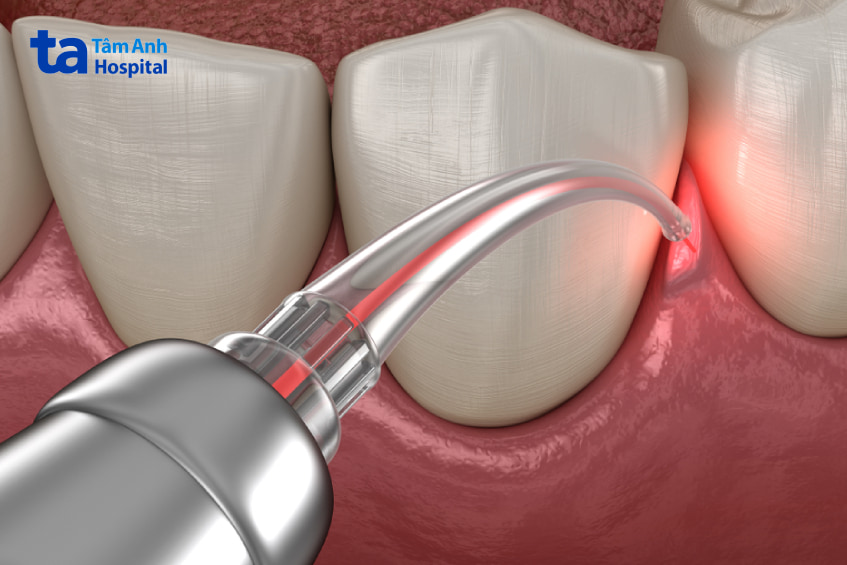Các phương pháp cắt lợi trùm răng khôn