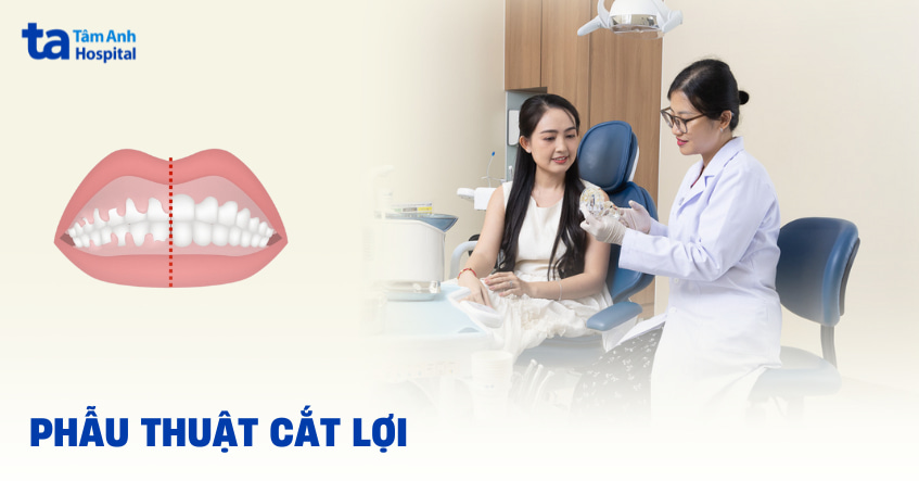 cắt lợi