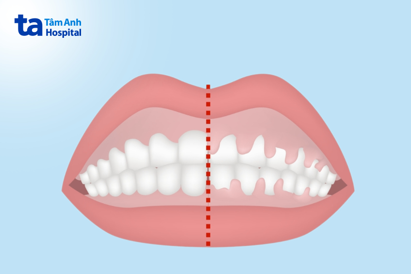 Cắt lợi phì đại do u