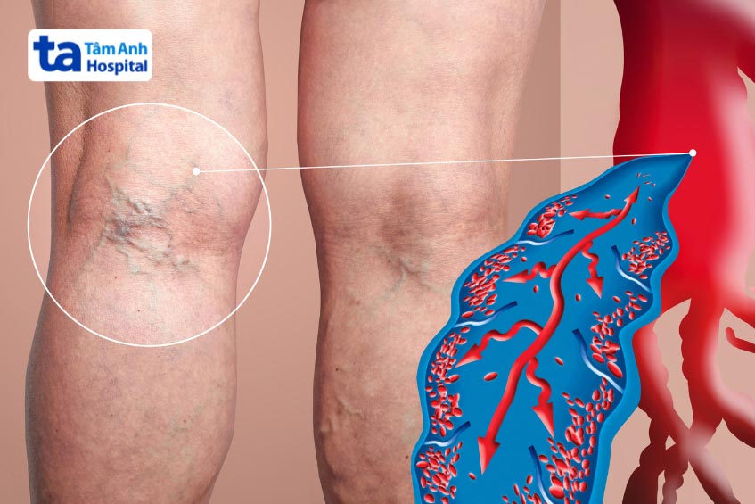 Chân của bệnh nhân bị huyết khối tĩnh mạch sâu với các đường mạch máu hiện rõ