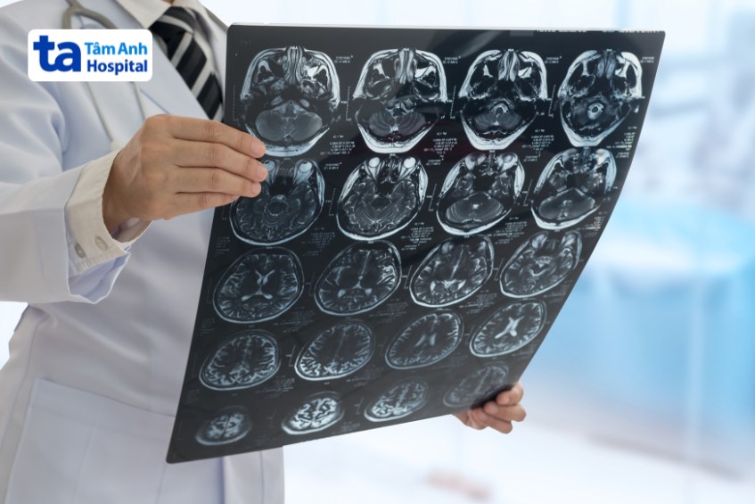 chẩn đoán trước khi phẫu thuật bắc cầu động mạch não