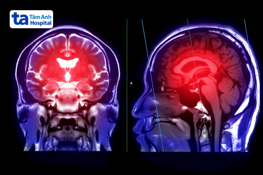 chẩn đoán xuất huyết não ở người trẻ tuổi