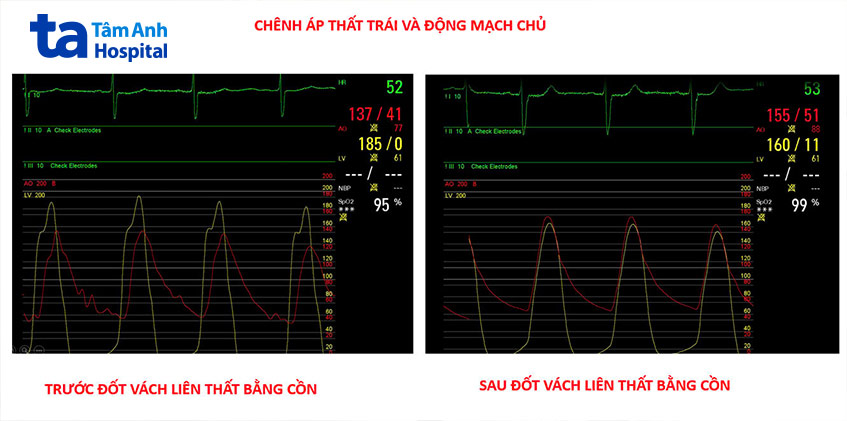 Chênh áp cải thiện sau khi thực hiện thủ thuật