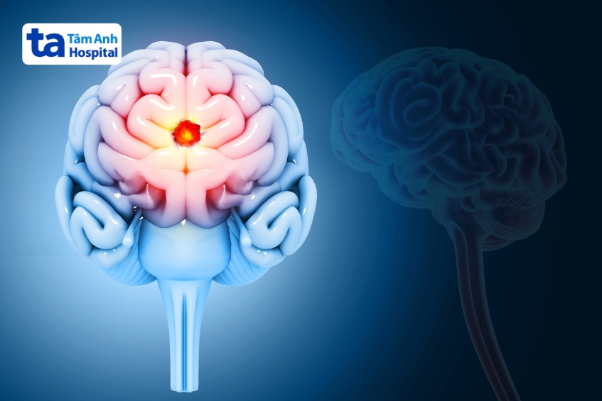 chỉ định mổ não trong trường hợp cần thiết