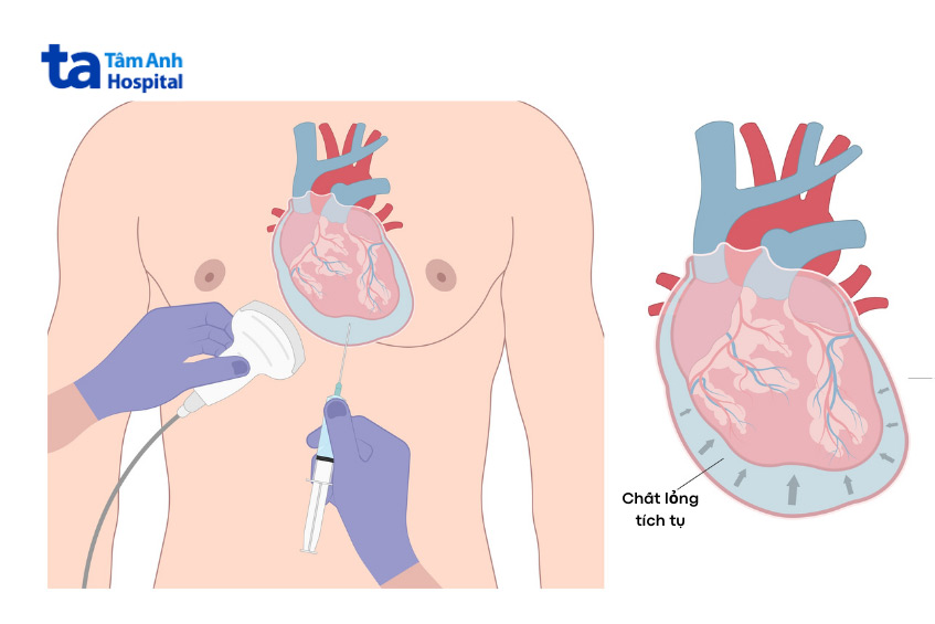 Chọc hút dịch màng ngoài tim giúp loại bỏ chất dịch gây chèn ép tim