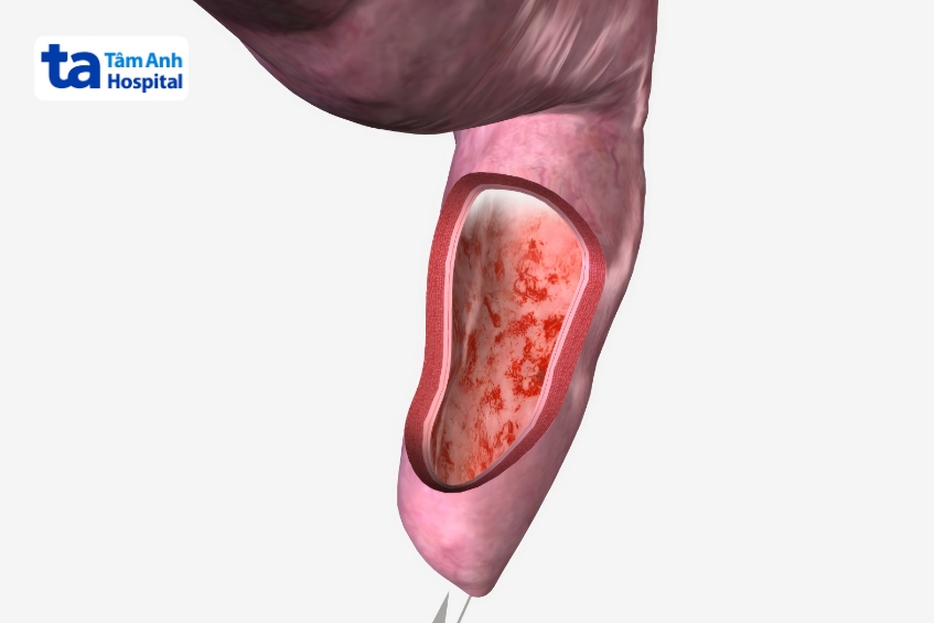 chữa viêm trực tràng