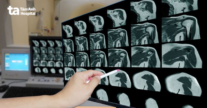 Chuẩn đoán bằng hình ảnh là phương pháp phổ biến để xác định u mỡ