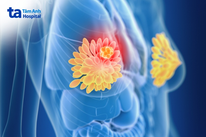 chụp mri vú và chụp nhũ ảnh