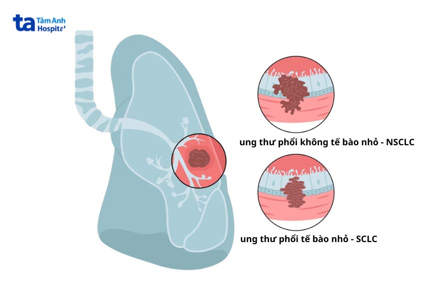 Có 2 loại ung thư phổi