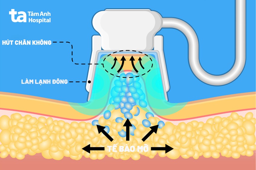 công nghệ đông hủy mỡ
