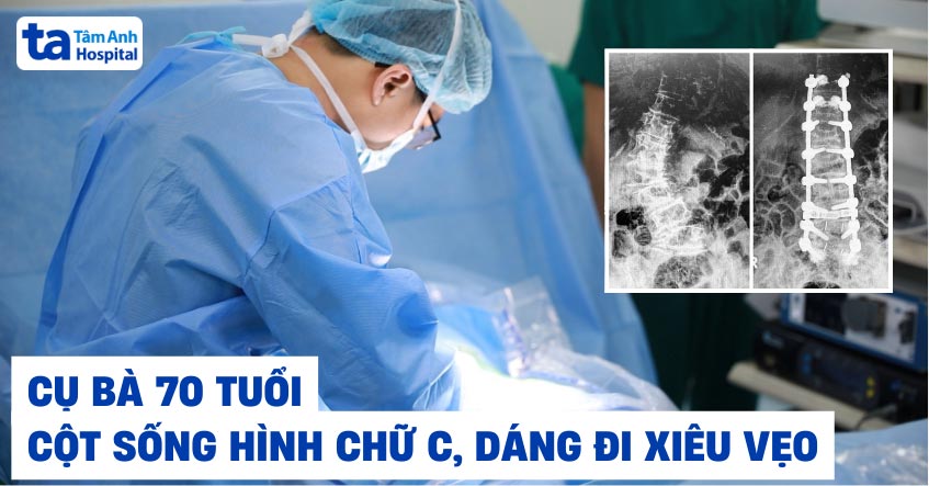 Cụ bà 70 tuổi đi xiêu vẹo do cột sống như chữ C