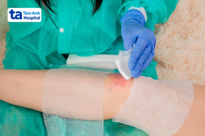 Đặt miếng gạc mới, không dính lên vết bỏng