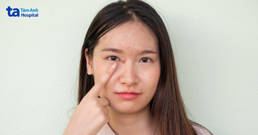 dấu hiệu bị mụn cứng dưới da