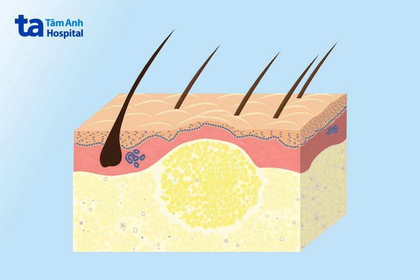 Dấu hiệu nhận biết u mỡ trên vai