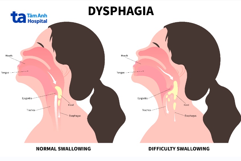 điều trị khó nuốt