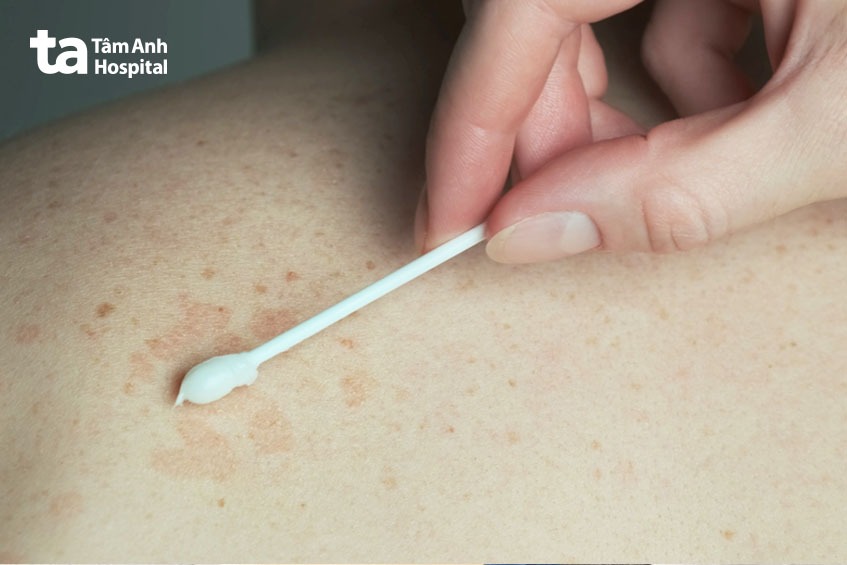 điều trị lang ben ở lưng