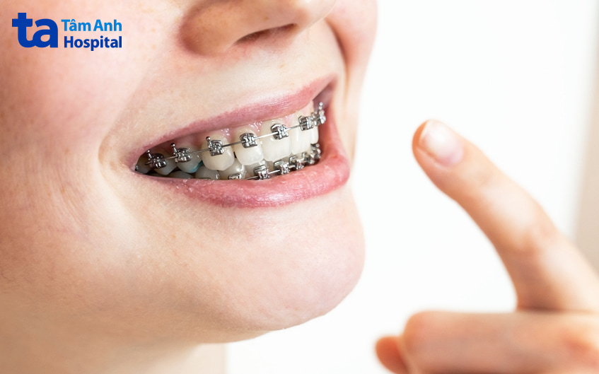 Cách chữa răng mọc lệch, niềng răng