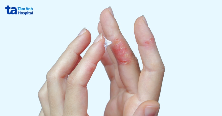 điều trị viêm da cơ địa ở tay