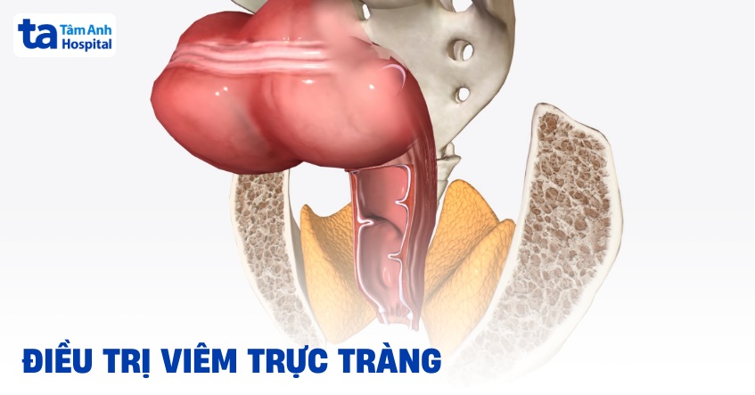 Phương pháp điều trị viêm trực tràng như thế nào hiệu quả?