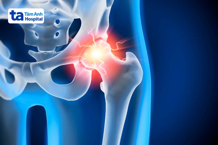 Đối tượng bị đau khớp háng đang dần trẻ hóa