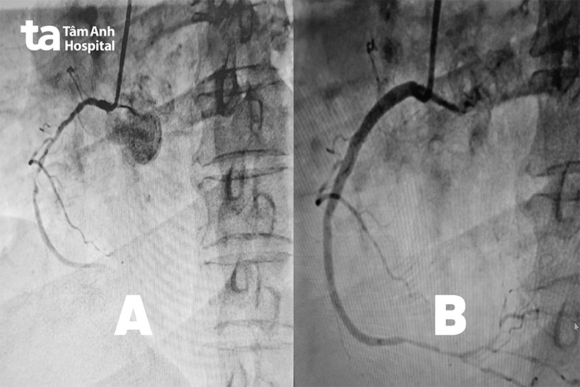 Động mạch vành phải hẹp nặng (hình A) và sau khi được nong mạch đặt stent (hình B)