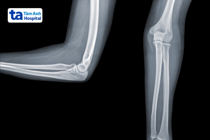 giá chụp x quang khuỷu tay