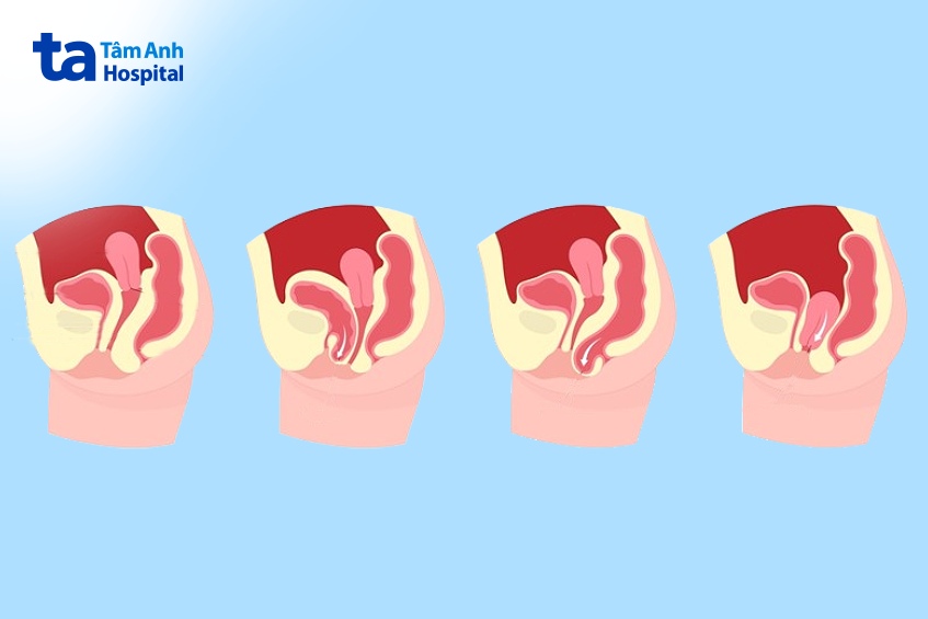 giai đoạn sa bàng quang ở nữ