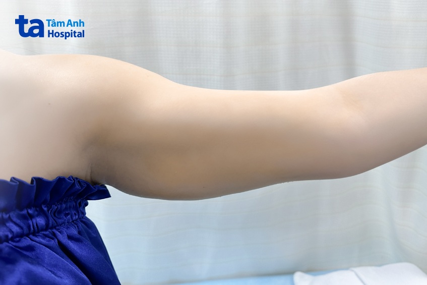Giải quyết bắp tay to như hộ pháp