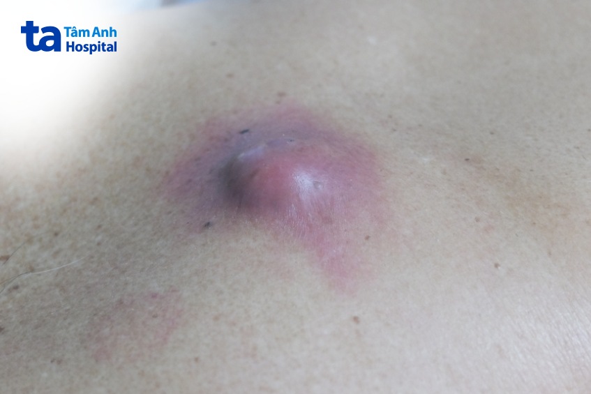 hình ảnh của u bã đậu ở mông