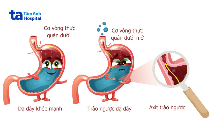 Hình ảnh dạ dày khỏe mạnh và dạ dày bị trào ngược