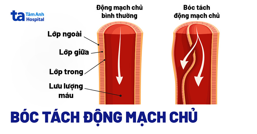 Hình ảnh động mạch chủ bình thường và bóc tách động mạch chủ