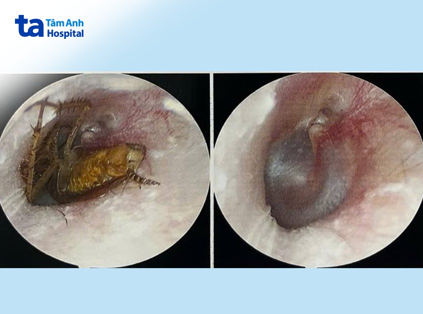 hình ảnh gián chui vô tai